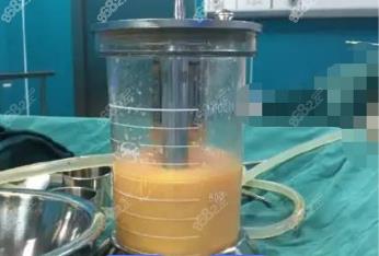 萍乡360度水动力吸脂费用多少钱？
